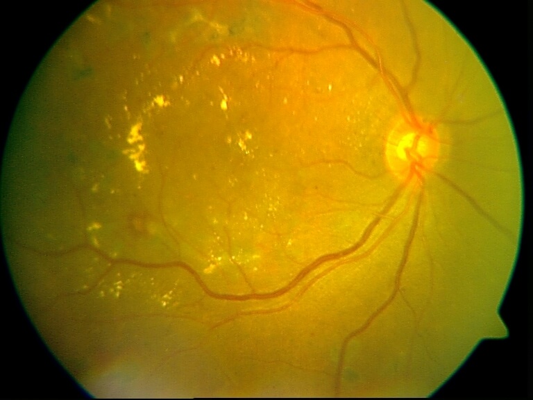 Diabetic Macular Edema