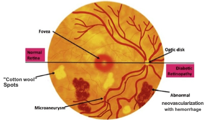 DIABETIC RETINOPATHY SURGERY