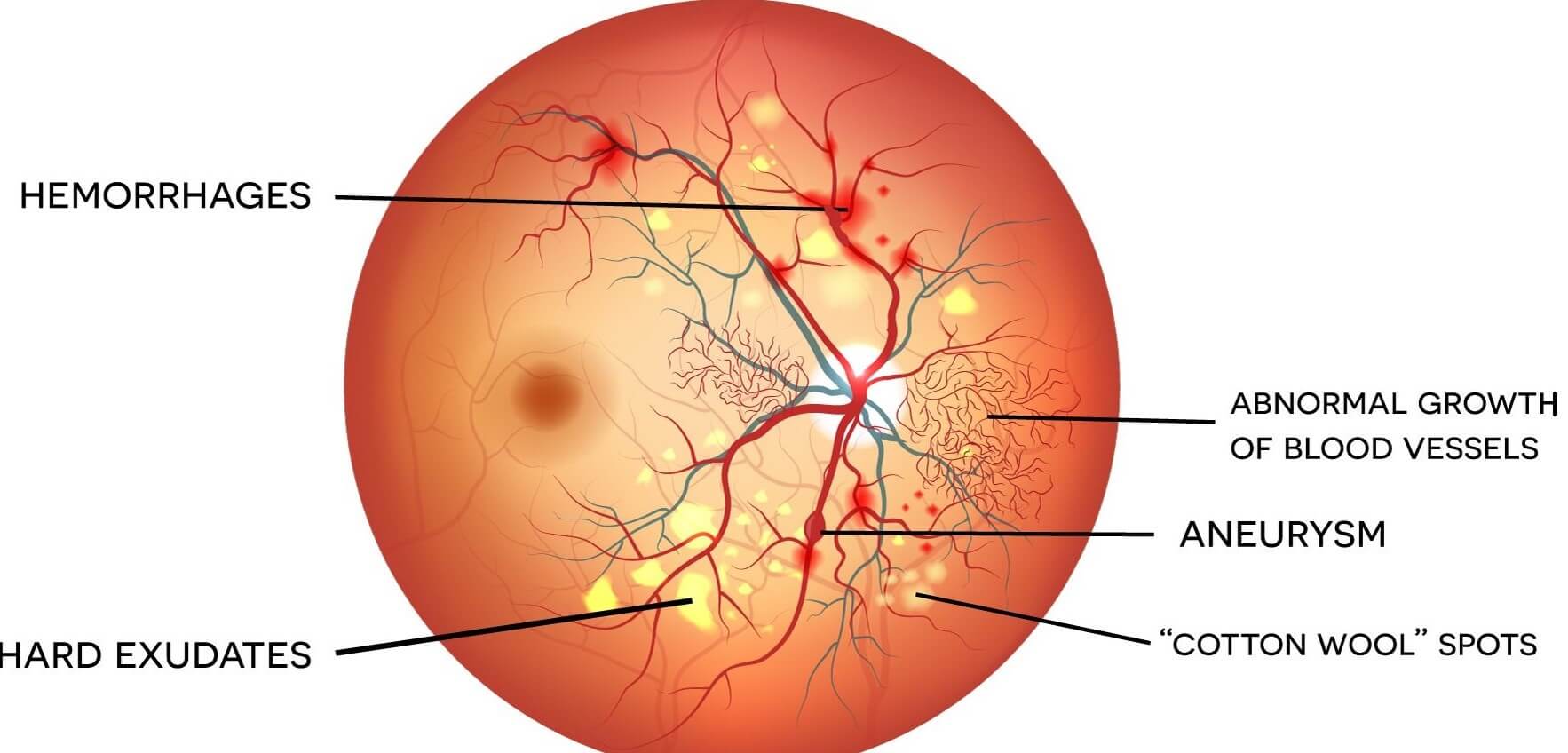 DIABETIC RETINOPATHY SURGERY