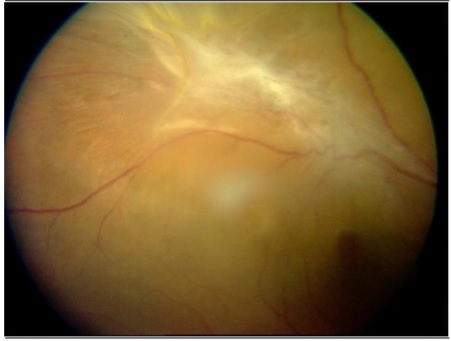 epiretinal-membrane-surgery