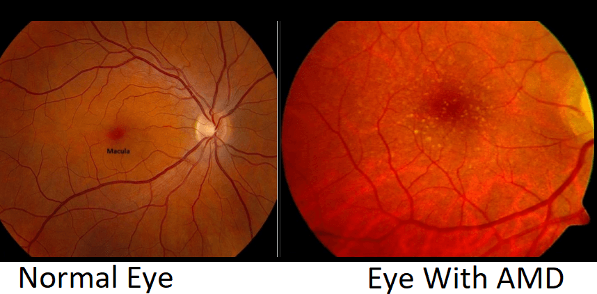 macular-degeneration