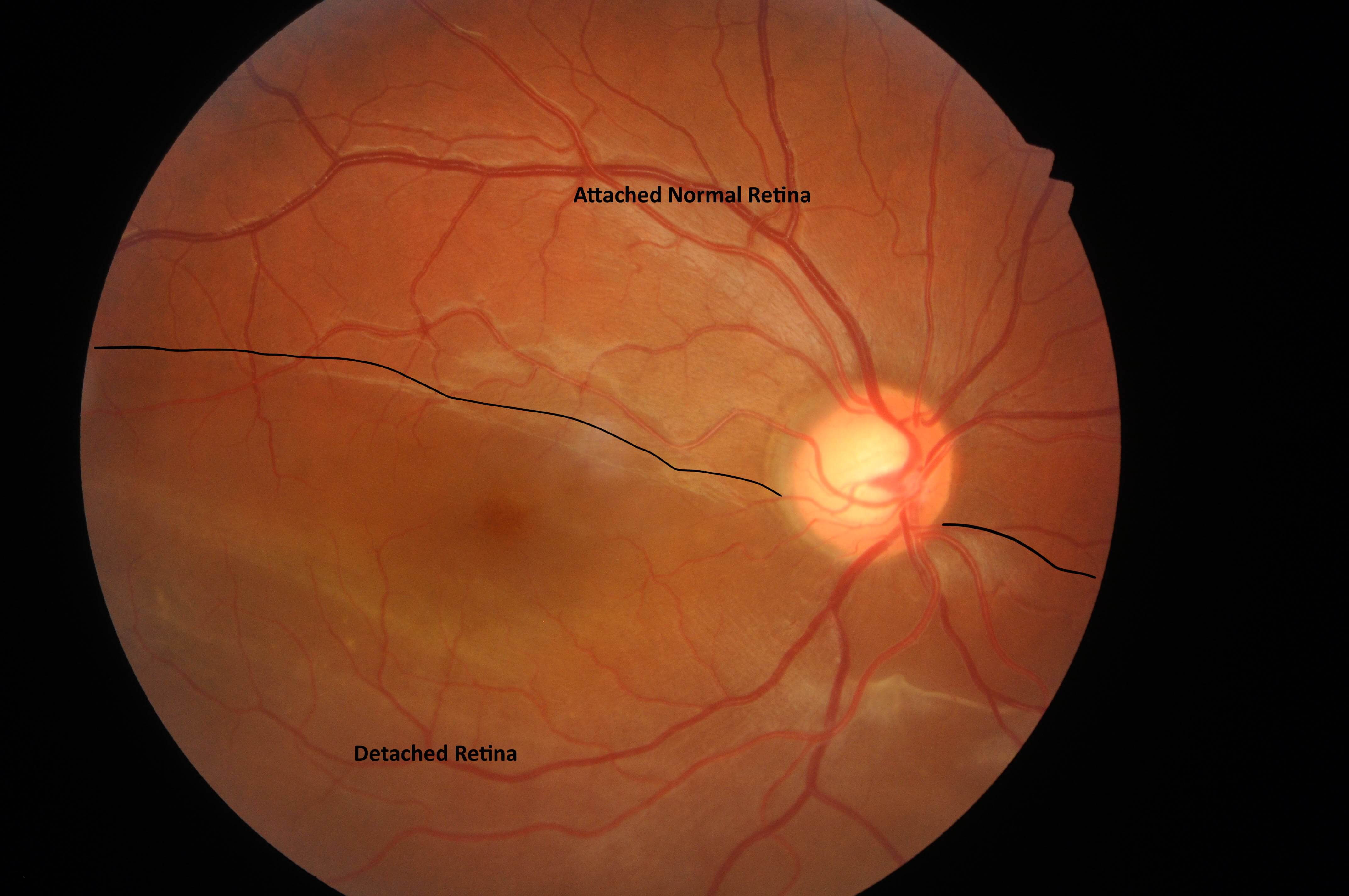 retinal-detachment