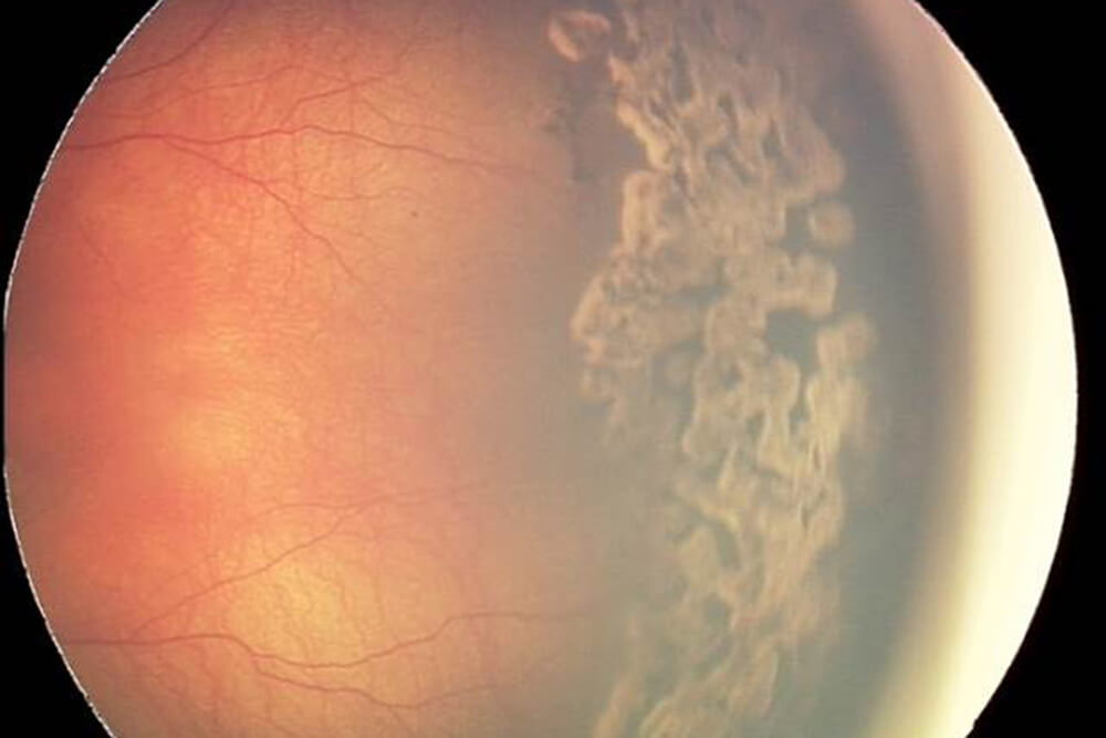 retinopathy-of-prematurity1