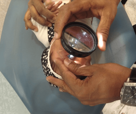 Retinopathy of Prematurity