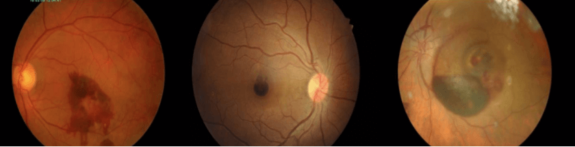 submacular-hemoorhage