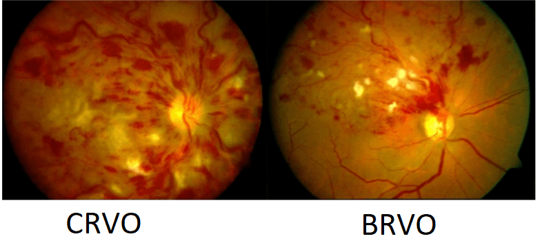 Retinal Vein Occlusion