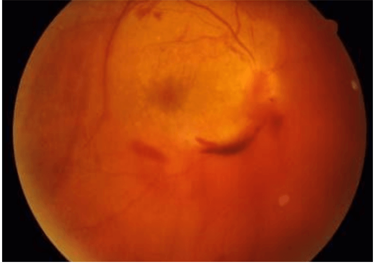 Vitreous Haemorrhage