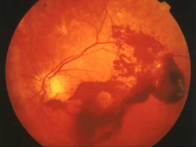 vitreous hemorrhage